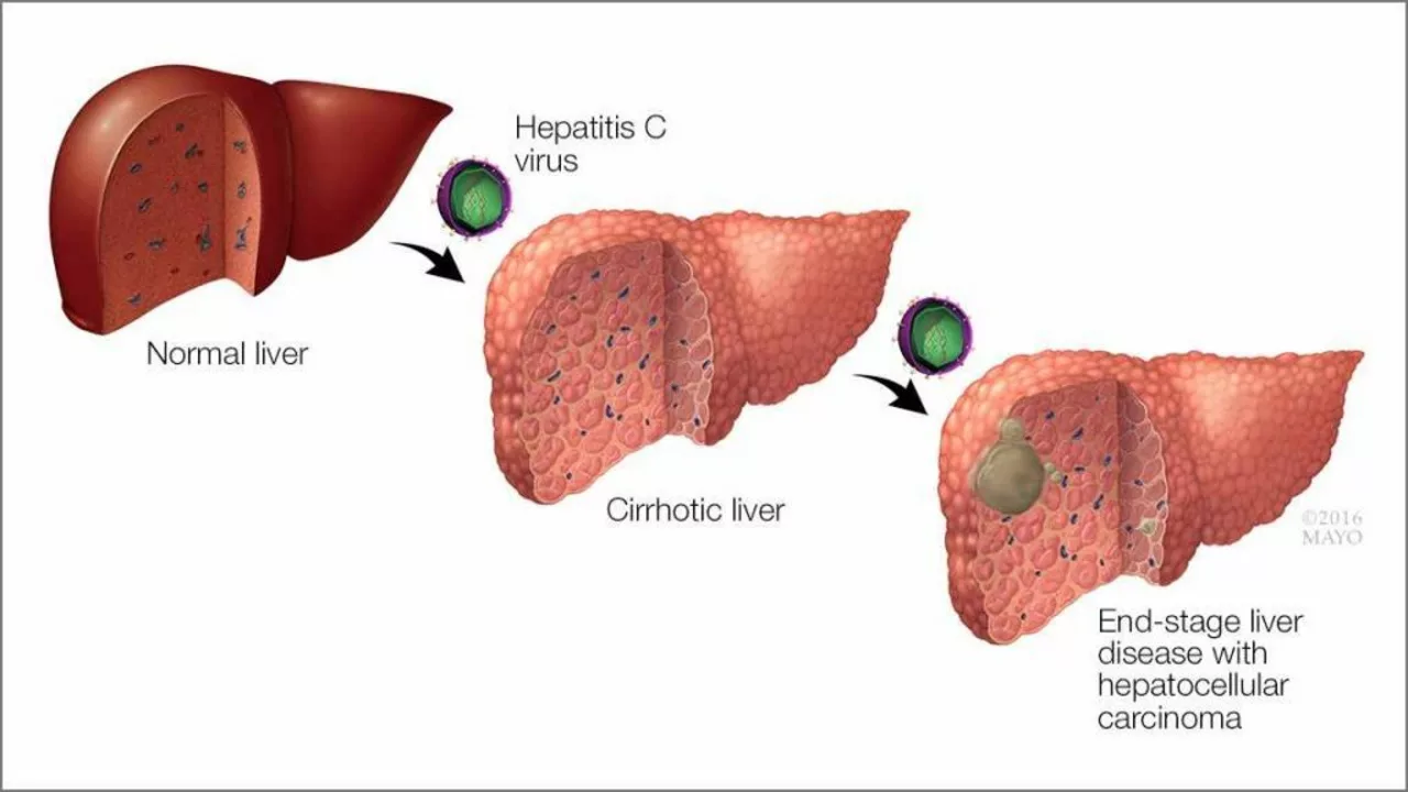 The Connection Between Genotype 3 Chronic Hepatitis C and Liver Cancer